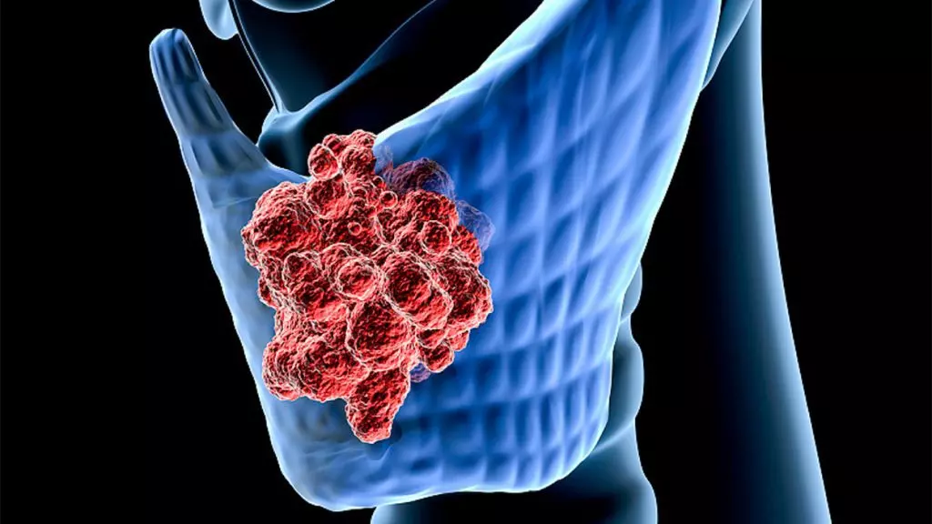 سرطان تیروئید 1 Follicular thyroid cancer 1 1024x576 1