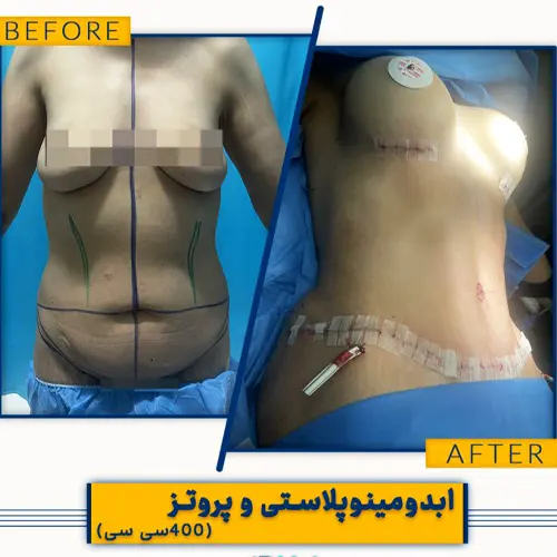 نمونه کار جراحی زیبایی ابدومینوپلاستی|دکتر علیرضا نگهی