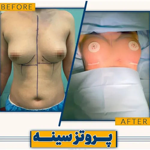 نمونه کار جراحی زیبایی پروتز سینه|دکتر علیرضا نگهی