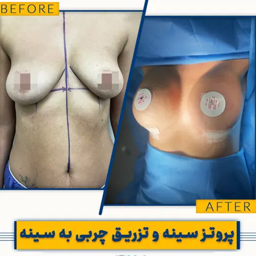 نمونه کار جراحی زیبایی تزریق چربی به سینه|دکتر علیرضا نگهی