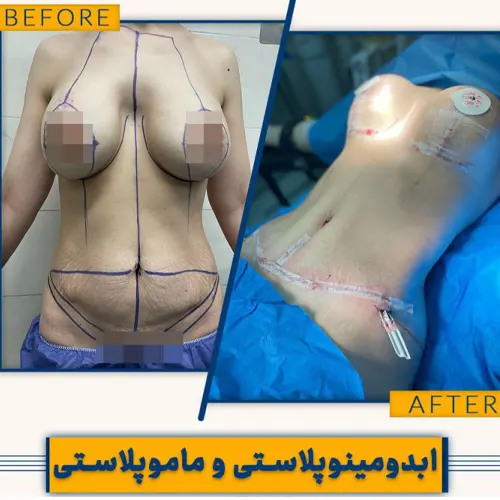 نمونه کار جراحی زیبایی ماموپلاستی|دکتر علیرضا نگهی