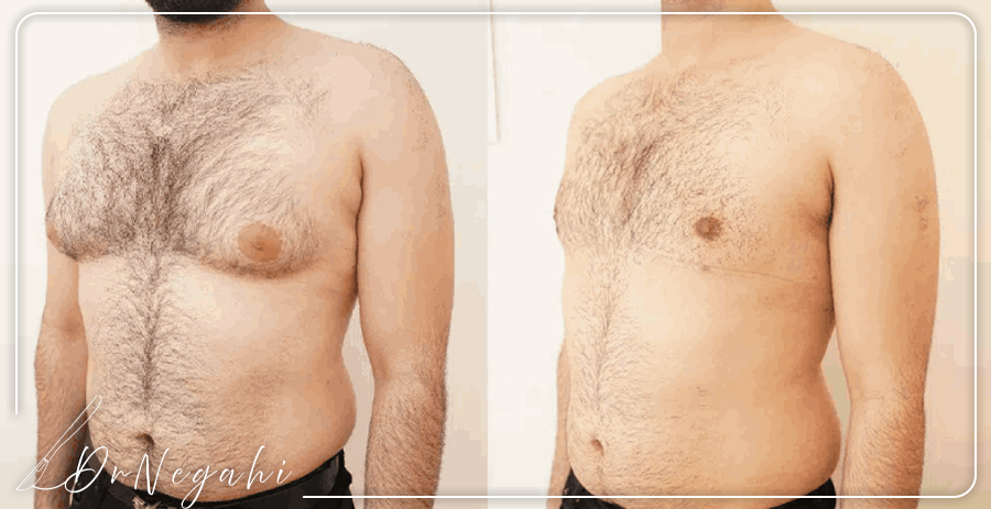 جراحی ژنیکوماستی؛ درمان بزرگ شدن سینه در آقایان