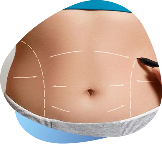 header abdominoplasty 1