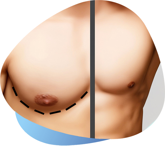 header gynecomastia
