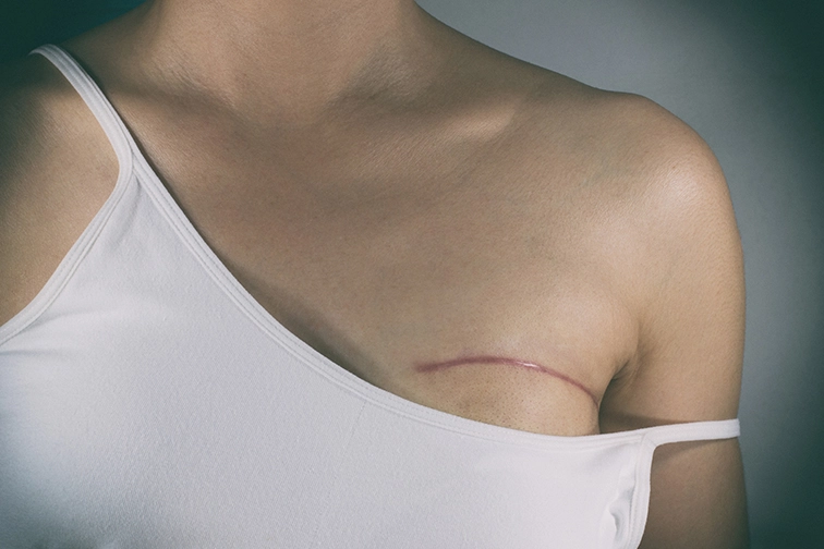 breast cancer surgery