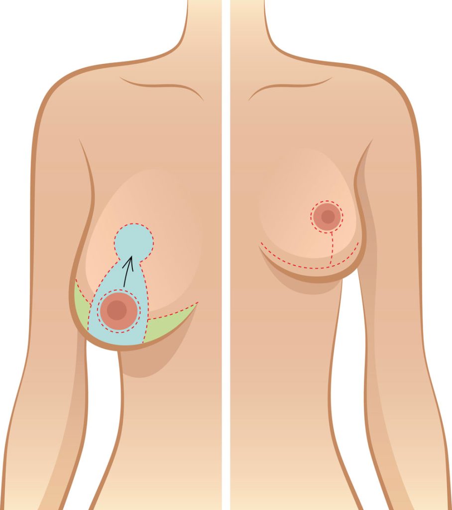 افتادگی سینه بعد شیردهی